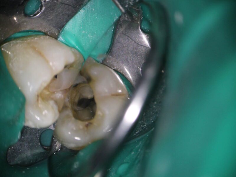 Precisión y eficacia en el tratamiento de endodoncia hecho con microscopio