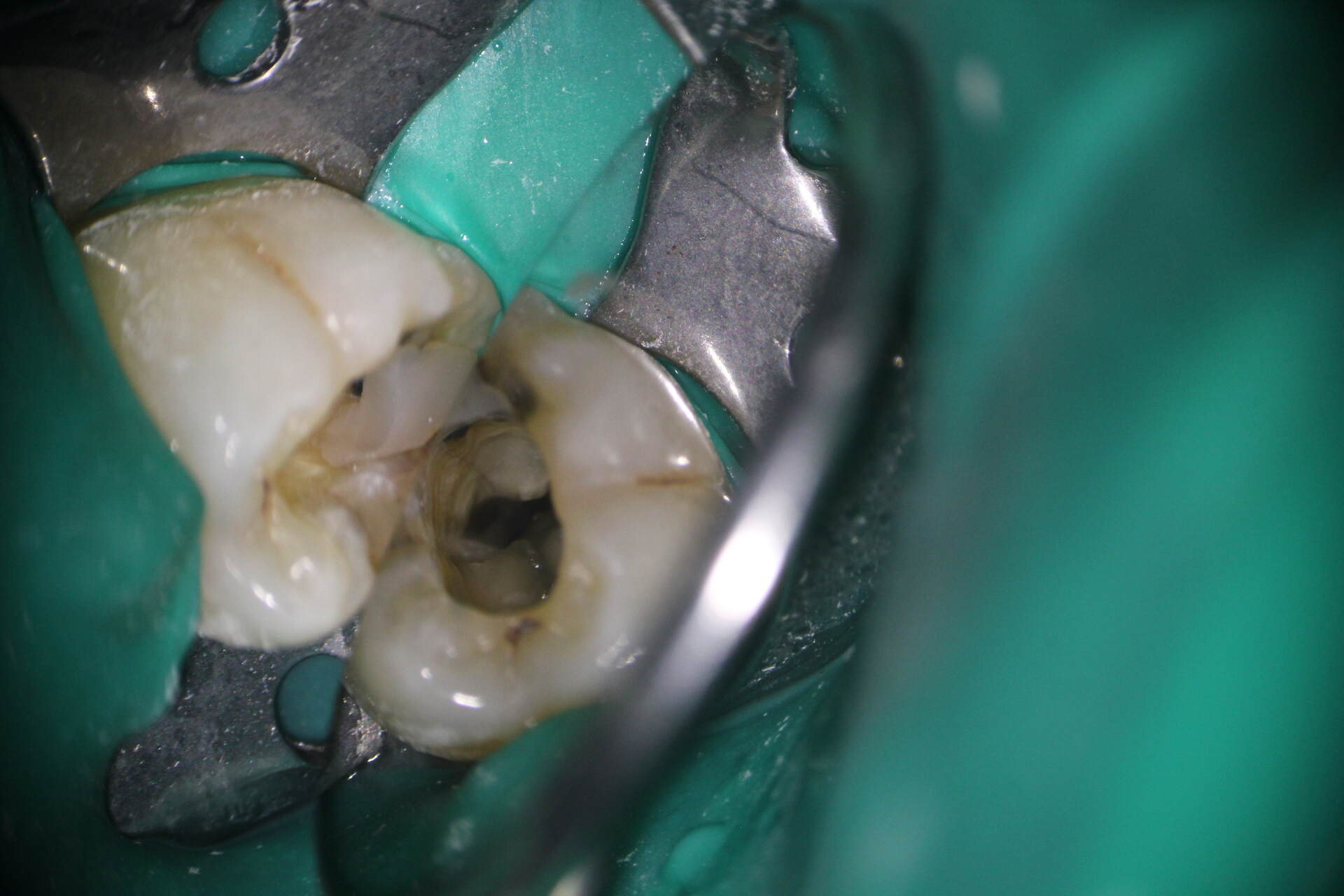 Precisión y eficacia en el tratamiento de endodoncia hecho con microscopio